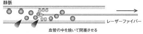 レーザーを用いた静脈瘤治療の流れ